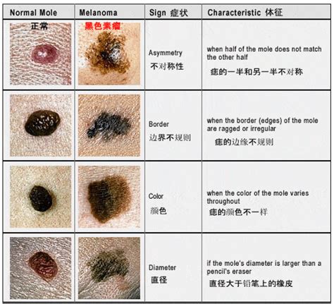 大黑痣|痣也可能会癌变！长在 3 个地方要注意